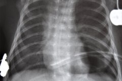 enfisema-lobar-congenito-tubo-de-torax-iatrogenico-vda-diferencia-estomago-007
