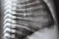 enfisema-retroesternal-000