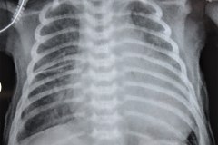 enfisema-subcutaneo-2003-001
