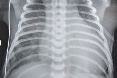 enfisema-subcutaneo-2003-003