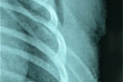 enfisema-subcutaneo-derrame-pleural-basal-izq-2005-000