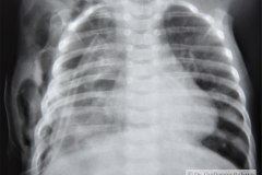 enfisema-subcutaneo-000