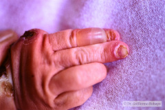 epidermolisis-ampollosa-1987-06-002