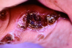 epidermolisis-ampollosa-1987-06-003