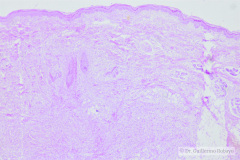 epidermolisis-ampollosa-1987-06-006