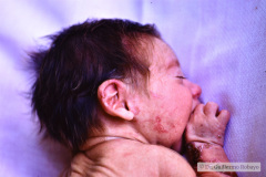 epidermolisis-ampollosa-1987-06-007