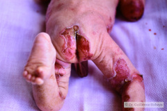 epidermolisis-ampollosa-1987-06-008