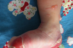 epidermolisis-ampollosa-2004-005