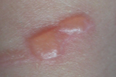 epidermolisis-ampollosa-2004-007