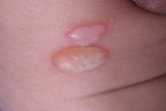 epidermolisis-ampollosa-2004-016