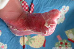 epidermolisis-ampollosa-2004-023