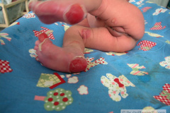 epidermolisis-ampollosa-2004-024
