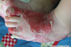 epidermolisis-ampollosa-2004-028
