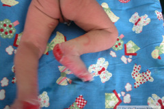 epidermolisis-ampollosa-2004-032