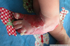 epidermolisis-ampollosa-2004-033
