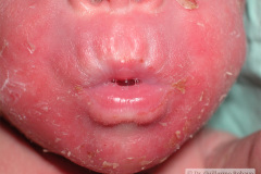 epidermolisis-ampollosa-simple-2009-006