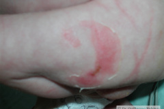 epidermolisis-ampollosa-simple-2009-008