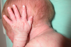 epidermolisis-ampollosa-simple-2009-009