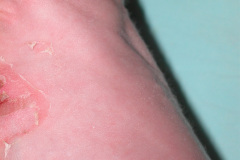 epidermolisis-ampollosa-simple-2009-012