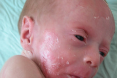 epidermolisis-ampollosa-simple-2009-015