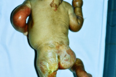 epidermolisis-ampollosa-union-1987-06-000