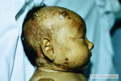 epidermolisis-ampollosa-union-1987-06-003