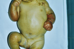 epidermolisis-ampollosa-union-1987-06-004