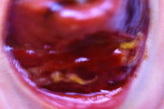 epulis-tumor-de-newmann-o-de-celulas-granulosas-002