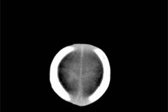 esclerosis-tuberosa-2007-023