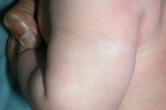 esclerosis-tuberosa-bcgitis-2003-005