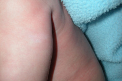esclerosis-tuberosa-bcgitis-2003-006