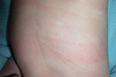 esclerosis-tuberosa-bcgitis-2003-010