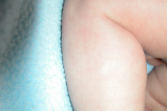 esclerosis-tuberosa-bcgitis-2003-012