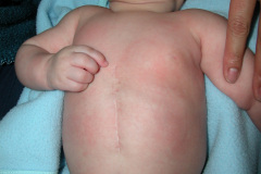 esclerosis-tuberosa-bcgitis-2003-013