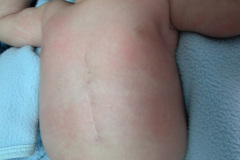 esclerosis-tuberosa-bcgitis-2003-014