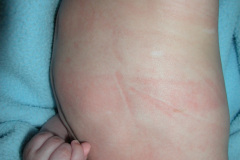 esclerosis-tuberosa-bcgitis-2003-018