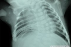 escoliosis-hemivertebras-fusion-costillas-1991-000