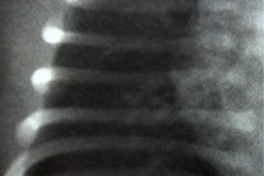 espina-bifida-hemivertebras-fision-costal-sup-der-costilla-supernumeraria-izq-13-002