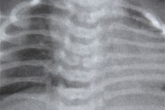 espina-bifida-t5-falta-fusion-apofisis-espinosa-001