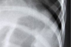 esplenomegalia-dextrocardia-000