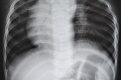 esplenomegalia-dextrocardia-001