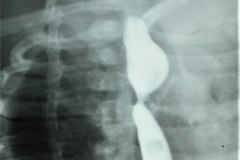 estenosis-esofagica-fistula-bronquial-postop-1985-004