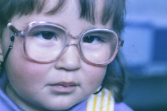 estrabismo-convergente-esotropia-endotropia-11m-1990-000