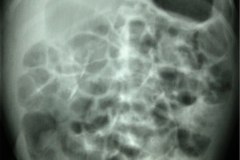 estrenosis-pieloureteral-dilatacion-de-pelvis-renal-izq-urografia-1984-001