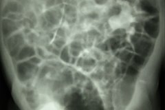 estrenosis-pieloureteral-dilatacion-de-pelvis-renal-izq-urografia-1984-003
