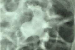 estrenosis-pieloureteral-dilatacion-de-pelvis-renal-izq-urografia-1984-006