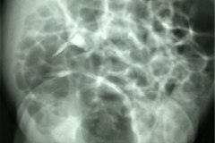 estrenosis-pieloureteral-dilatacion-de-pelvis-renal-izq-urografia-1984-007