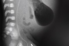 exanguinotransfusion-arteriovenosa-linea-arterial-femoral-izq-con-yelco-y-cateter-venoso-femoral-der-1996-000