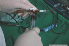 exanguinotransfusion-con-bombas-2002-001