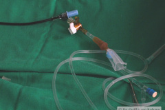 exanguinotransfusion-con-bombas-2002-011